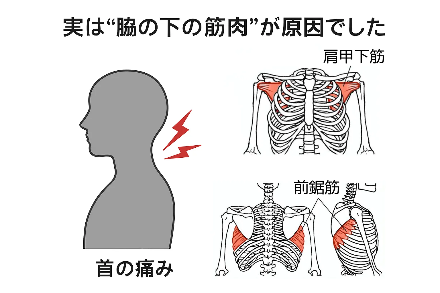 首が寝違えたように痛い…実は“脇の下の筋肉”が原因でした